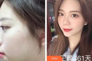 合肥大韓整形美容醫(yī)院張俊芳整形價格表附金屬托槽矯正案例展示