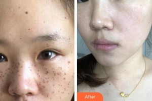 合肥丹鳳朝陽婦科醫(yī)院整形美容外科李淑珂整形價格表附祛斑案例展示
