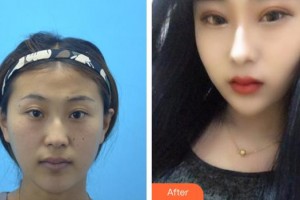 合肥崔勁松醫(yī)療美容診所崔向葵整形價格表附眼部案例展示