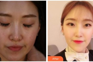 合肥壹加壹整形美容醫(yī)院王艷俠整形價格表附激光美膚激光案例展示