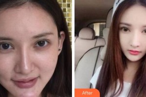 合肥壹加壹整形美容醫(yī)院蘇聖珉整形價格表附埋線提升案例展示