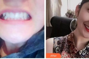 合肥恒美整形醫(yī)院趙家鳳整形價格表附牙齒陶瓷矯正案例展示
