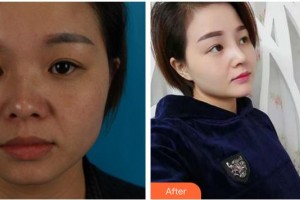 合肥恒美整形醫(yī)院廖亞敏整形價格表附耳軟骨復(fù)合隆鼻案例展示