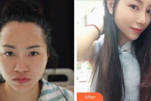 合肥凱美醫(yī)療美容醫(yī)院李立國整形價格表附肋軟骨隆鼻案例展示