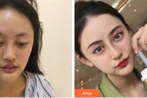 合肥亞典整形美容醫(yī)院陳超群整形價格表附鼻部綜合案例展示