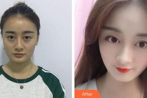 合肥亞典整形美容醫(yī)院吳邊整形價格表附耳軟骨復(fù)合隆鼻案例展示
