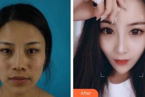 合肥藝星醫(yī)療美容醫(yī)院孫洋整形價格表附肋軟骨隆鼻案例展示