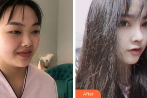 合肥凱美醫(yī)療美容醫(yī)院胡啟能整形價格表附眼部修復(fù)案例展示