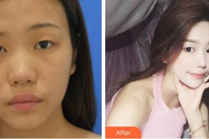 合肥凱美醫(yī)療美容醫(yī)院孫凱整形價格表附祛眼袋案例展示