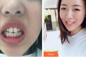 合肥艾雅整形美容醫(yī)院仇凌波整形價格表附隱形托槽矯正案例展示
