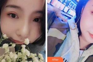 合肥艾雅整形美容醫(yī)院吳宇萌整形價格表附牙齒隱形矯正案例展示