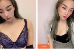 合肥天鵝湖整形美容醫(yī)院余式普整形價格表附自體脂肪隆胸案例展示