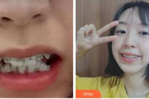 合肥崔勁松醫(yī)療美容診所張敦苗整形價格表附牙齒陶瓷矯正案例展示