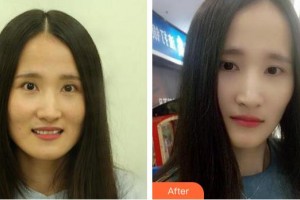合肥壹美尚美容醫(yī)院張慧烽整形價格表附牙齒陶瓷矯正案例展示