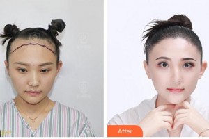 合肥源森美容整形外科診所曹守己整形價(jià)格表附種植發(fā)際線(xiàn)案例展示