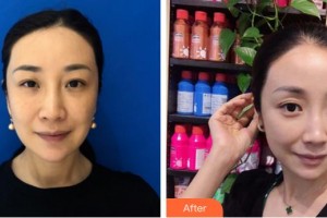 合肥美舒雅醫(yī)療美容診所王軍整形價(jià)格表附埋線(xiàn)提升案例展示