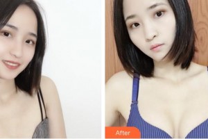 合肥美舒雅醫(yī)療美容診所席慶春整形價(jià)格表附自體脂肪隆胸案例展示