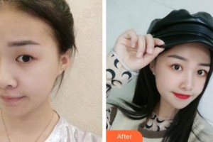 合肥美舒雅醫(yī)療美容診所李亞會(huì)整形價(jià)格表附切開(kāi)雙眼皮案例展示