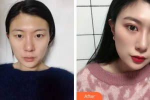 合肥美舒雅醫(yī)療美容診所尹洋整形價(jià)格表附切開(kāi)雙眼皮案例展示