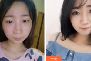 合肥玉顏醫(yī)療美容門(mén)診部翁曉娟整形價(jià)格表附切開(kāi)雙眼皮案例展示