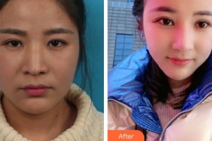 合肥恒美整形醫(yī)院陳亮整形價(jià)格表附眼部綜合案例展示