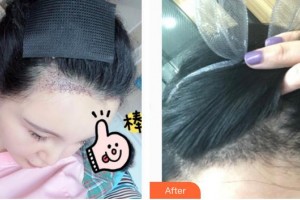 合肥新生植發(fā)醫(yī)院劉維整形價(jià)格表附種植發(fā)際線(xiàn)案例展示
