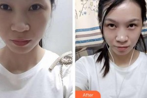 合肥愛(ài)爾眼科醫(yī)院朱華美整形價(jià)格表附眼部修復(fù)案例展示