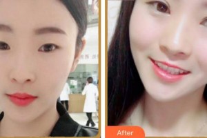 合肥愛(ài)爾眼科醫(yī)院李凱整形價(jià)格表附雙眼皮案例展示