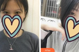 合肥愛(ài)爾眼科醫(yī)院王芳榮整形價(jià)格表附眼部案例展示