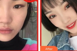 合肥愛(ài)爾眼科醫(yī)院王紅巖整形價(jià)格表附眼部綜合案例展示