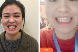合肥瑞特曼口腔門(mén)診部黃志整形價(jià)格表附牙齒隱形矯正案例展示
