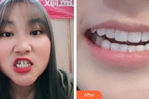 合肥拜博口腔醫(yī)院程旭整形價(jià)格表附牙貼面案例展示