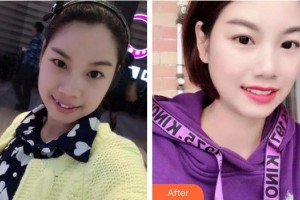 合肥拜博口腔醫(yī)院徐美平整形價(jià)格表附牙綜合案例展示