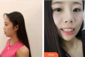 合肥拜博口腔醫(yī)院李銅美整形價(jià)格表附牙齒隱形矯正案例展示