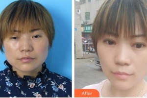 合肥東南眼科醫(yī)院葉玉華整形價(jià)格表附上瞼下垂、內(nèi)眼角案例展示