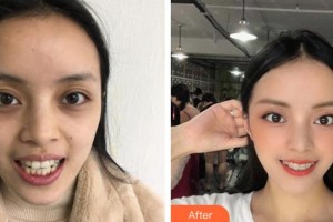蕪湖來(lái)友口腔門診部陳天蘊(yùn)整形價(jià)格表附牙齒矯正案例展示