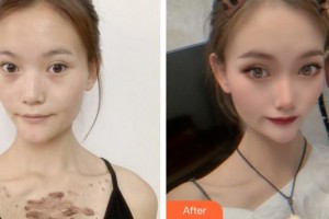 蚌埠市第三人民醫(yī)院燒傷整形科楊蔚整形價(jià)格表附微創(chuàng)疤痕修復(fù)案例展示
