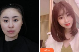 蚌埠美萊塢整形美容醫(yī)院趙士駿整形價(jià)格表附膠原蛋白除皺案例展示