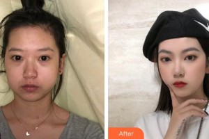 蚌埠韓麗整形美容醫(yī)院金男昊整形價格表附下頜角整形案例展示