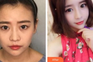 蚌埠靚妹醫(yī)療美容門診部葉麗琴整形價格表附熱瑪吉案例展示