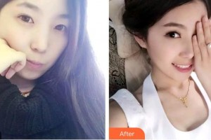 蚌埠華美整形美容門診部閆路整形價格表附金屬托槽矯正案例展示