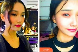 蚌埠韓美美萊醫(yī)療美容門診部陳澤整形價格表附熱瑪吉案例展示