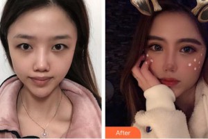 蚌埠康視眼科醫(yī)院鄒杰整形價格表附切開雙眼皮案例展示