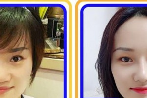 蚌埠市第一人民醫(yī)院整形外科田宇虹整形價(jià)格表附開外眼角案例展示