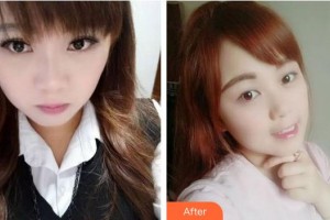 蚌埠三愛口腔門診部張迪整形價(jià)格表附牙齒隱形矯正案例展示