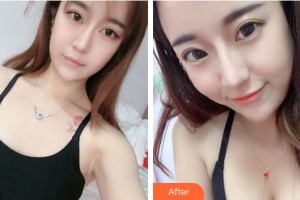 淮南瑞麗醫(yī)療美容門診部樸鐘洙整形價(jià)格表附自體脂肪隆胸案例展示
