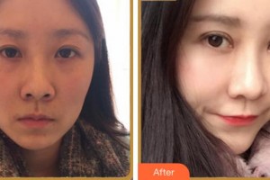 淮南晨光眼科醫(yī)院韓新繼整形價(jià)格表附眼部綜合案例展示