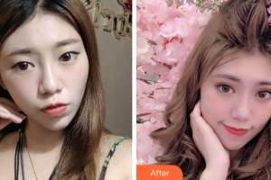淮南晨光眼科醫(yī)院韓冬梅整形價(jià)格表附眼部綜合案例展示