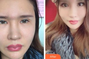淮南鳳凰醫(yī)院眼科宮斌整形價(jià)格表附眼部修復(fù)案例展示