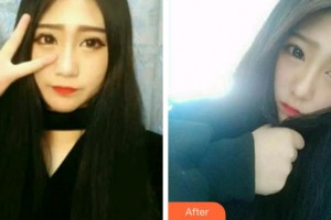 淮南安美口腔門(mén)診部楊博翰整形價(jià)格表附牙齒隱形矯正案例展示